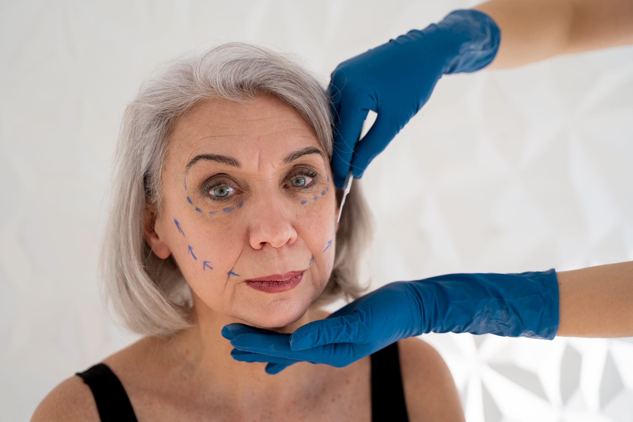 Illustrative facial ageing assessment showing treatment planning markings